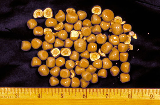 calcium oxalate crystals kidney stones